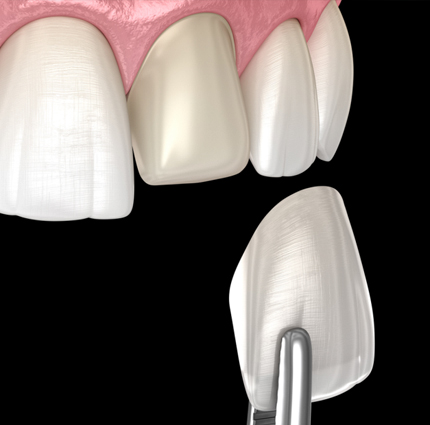 이백점 심미보철