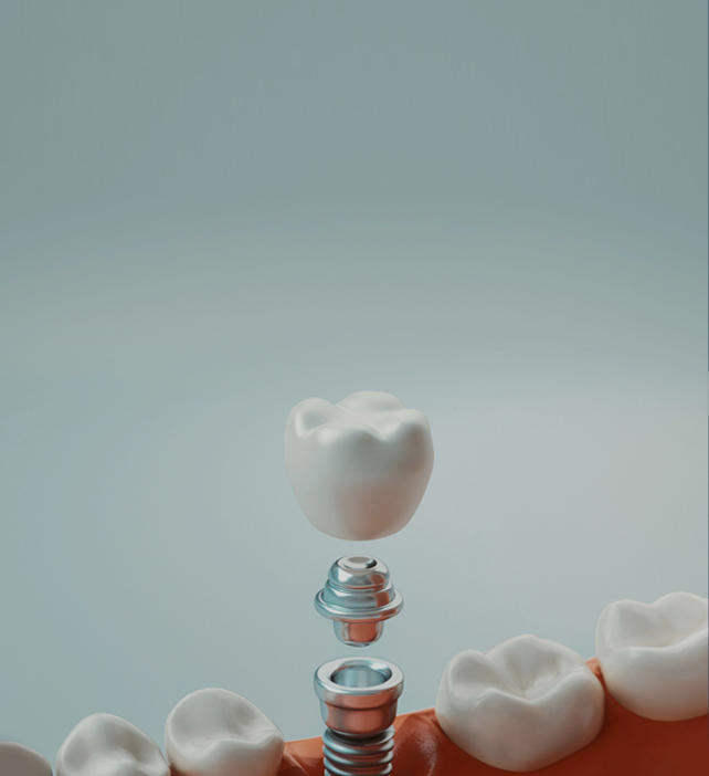 임플란트